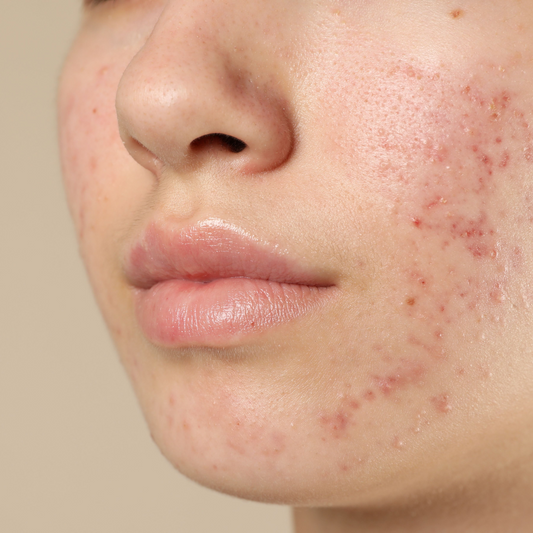 Acne Relief Gezichtbehandeling, Studio Lunéa